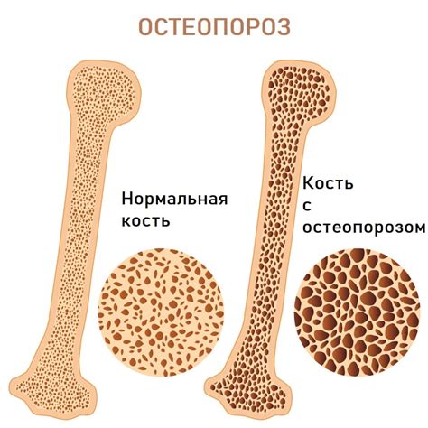 Снижение плотности костей и риск остеопороза