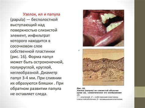 Снятие воспаления слизистой оболочки