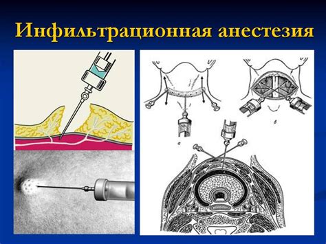 Современные тенденции в использовании проводниковой анестезии