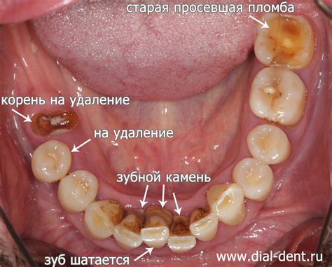 Современные толкования следов от выпавшего зуба