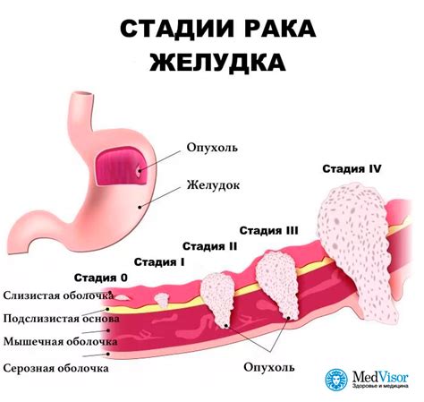 Сон о раке желудка: предвестник недуга или просто символическое изображение?