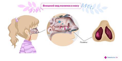 Сопряженные симптомы при потении в носу у ребенка