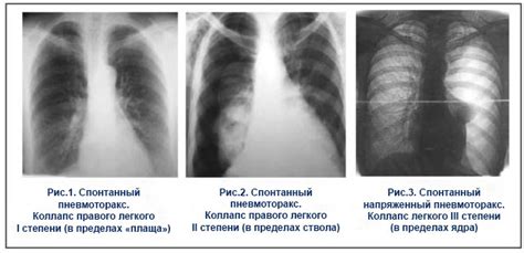 Способы диагностики гипоэктаза легкого