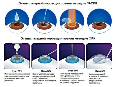 Сроки лазерной коррекции зрения