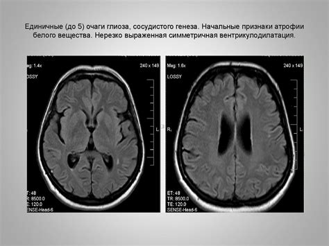 Супратенториальные очаги глиоза головного мозга