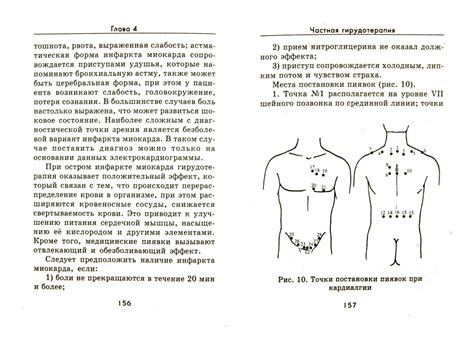 Схема размещения пиявок для похудения в различных частях тела