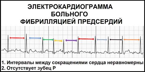 Тахистолическая форма фибрилляции предсердий