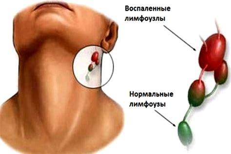 Температурный фактор и воспаление лимфоузла