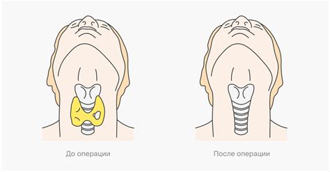 Типы операций по удалению узла на щитовидке