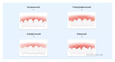 Травма десен