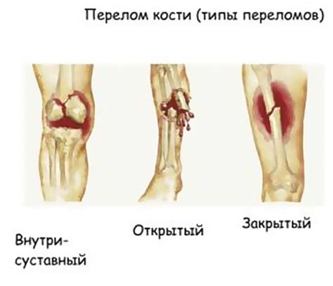 Травмы и переломы