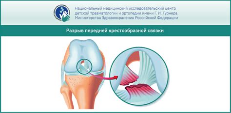 Травмы и повреждения в коленном суставе