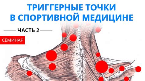 Триггерные точки: причины и проявления