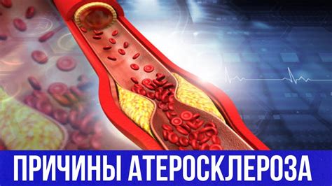 Увеличение риска наступления атеросклероза