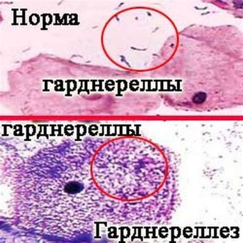 Уреаплазма у женщин: диагностика и значение положительного результата