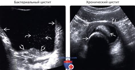 Утолщение стенок мочевого пузыря у мужчин