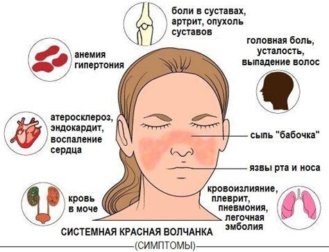 Факторы риска системной красной волчанки