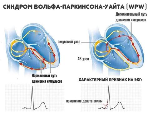 Характеристики и симптомы синдрома WPW