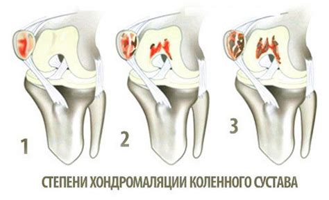 Хондромаляция надколенника 4 степени