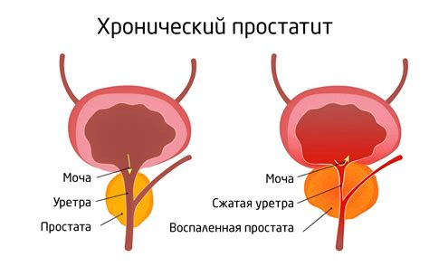 Хронический простатит: причины и лечение