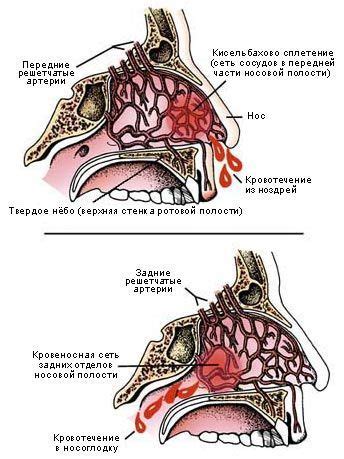 Что вызывает частые эпизоды носовых кровотечений