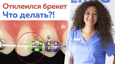 Что делать, если натерлось гуми от брекетов?