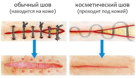 Что делать, если разошелся шов после кесарева сечения