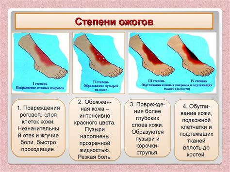 Что делать при ожоге от перца: эффективные способы облегчения