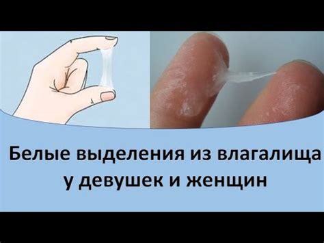 Что может быть причиной выделения белой жидкости из влагалища?