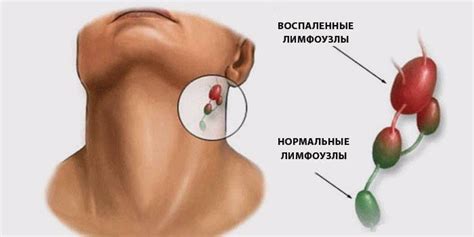 Что может спровоцировать воспаление лимфоузла?