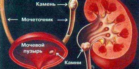 Что происходит, когда камень проходит по мочеточнику?