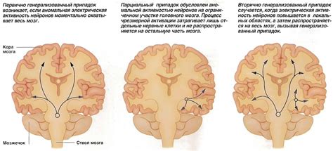 Что происходит при эпилепсии?