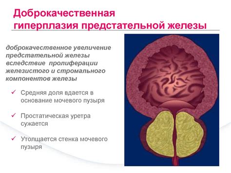 Что такое С61 ЗНО предстательной железы