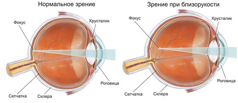 Что такое аномалия невидения одного глаза?