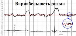 Что такое высокая вариабельность на КТГ?