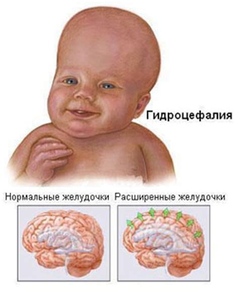 Что такое гидроцефалия головы?