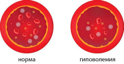 Что такое гиповолемия