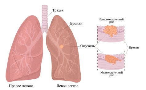 Что такое гипоэктаз легкого?