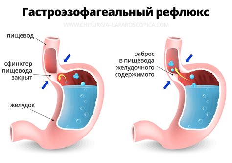 Что такое заброс желчи в пищевод?