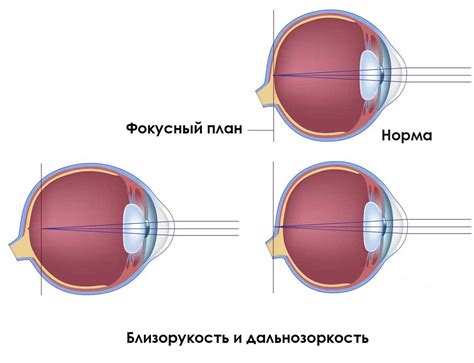 Что такое ослабленное зрение одного глаза?