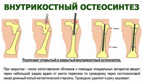 Что такое остеосинтез голени штифтом?