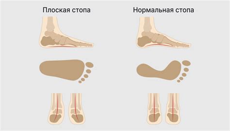 Что такое плоскостопие и как оно вызывает боли в ногах