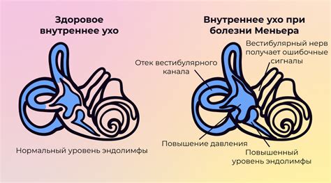 Что такое синдром Меньера и какие у него симптомы?