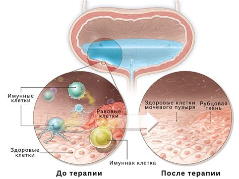 Что такое тур при раке мочевого пузыря