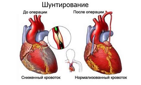 Что такое тяжелое состояние после шунтирования?