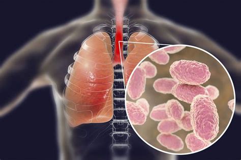 Что такое Bordetella pertussis?