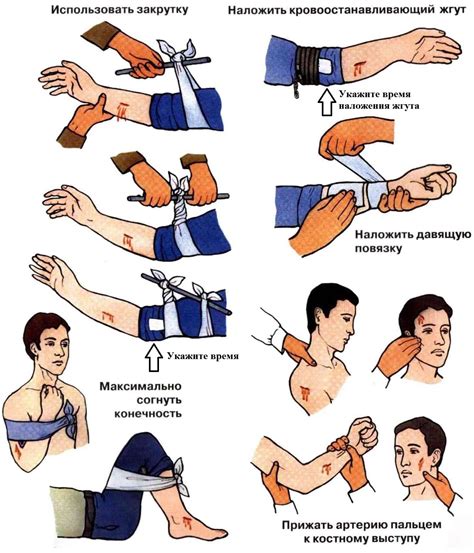Шаги для остановки кровотечения