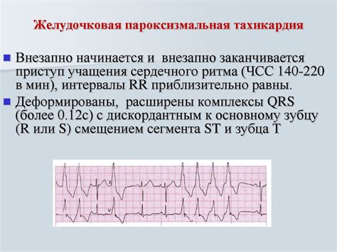 ЭКГ признаки гибернакулярного блока