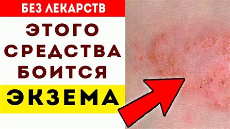 Экзема как одна из возможных причин