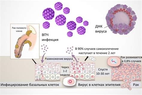  Как диагностируется генотип 51 впч 